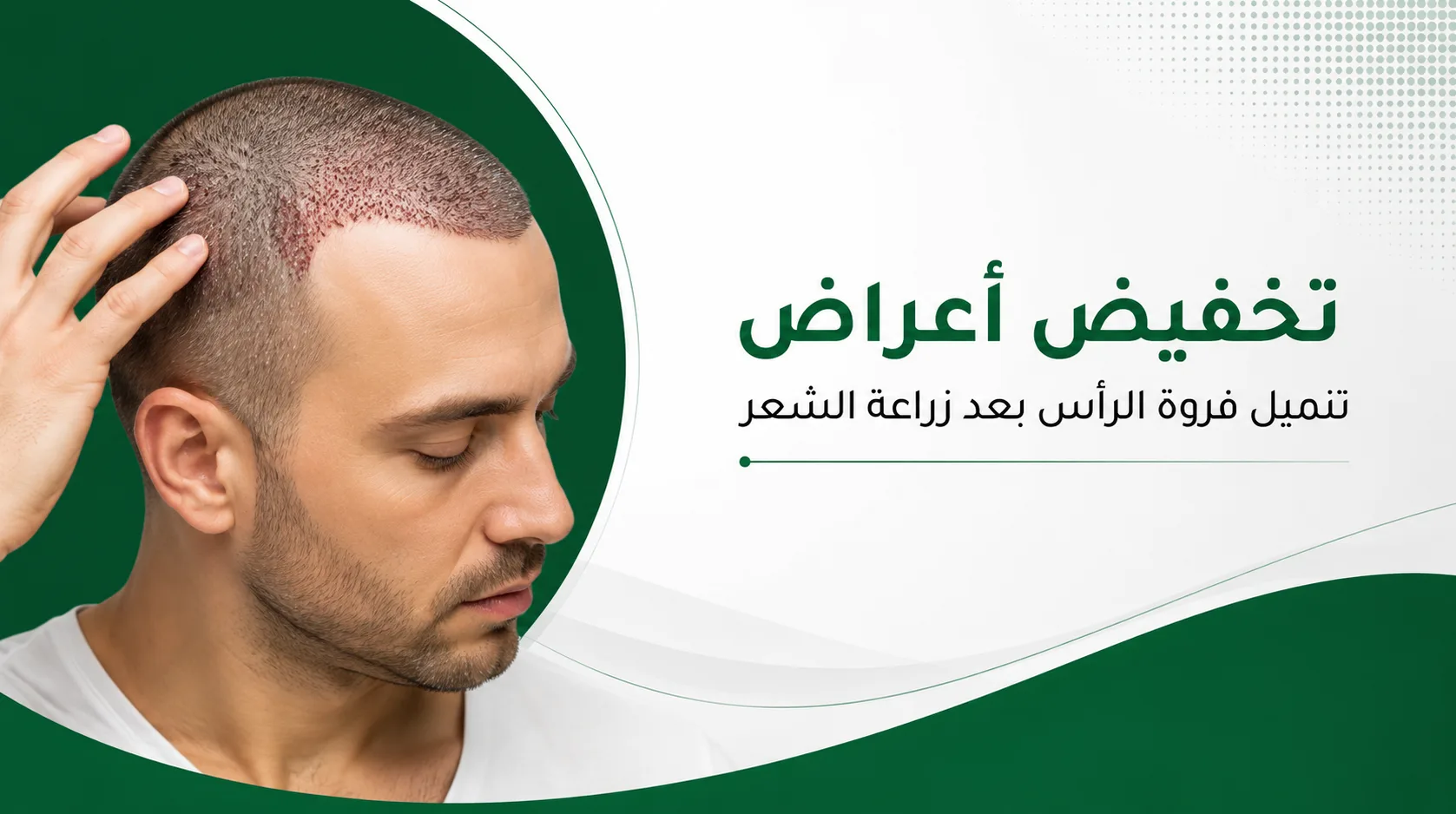 كيف يمكن التخفيف من أعراض خدر فروة الرأس بعد زراعة الشعر؟